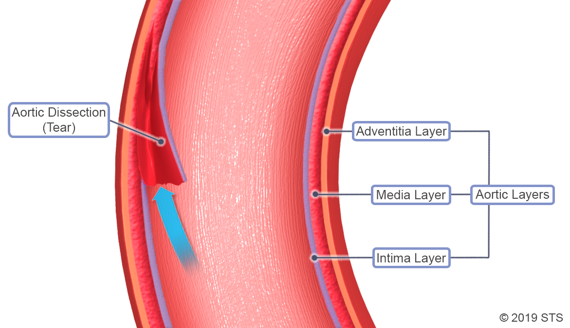 Aortic Dissection The Patient Guide To Heart Lung And Esophageal